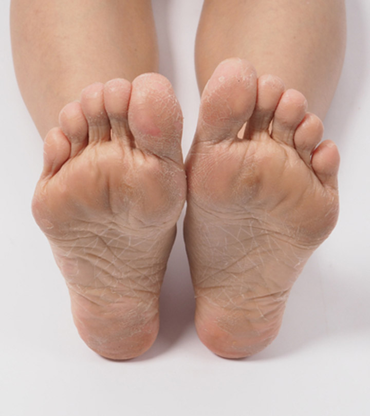 Moisturize to Help Heal Dry Cracked Heels