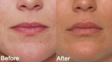 Lip augmentation to stop lip bleeding