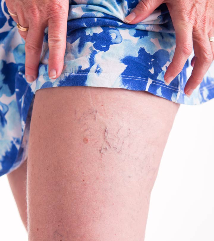 Natural Remedies For Varicose Veins