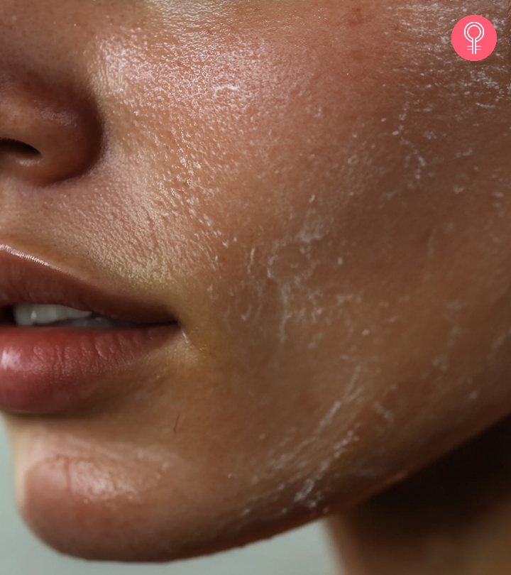 Skin Peeling Causes Symptoms And How To Reduce It