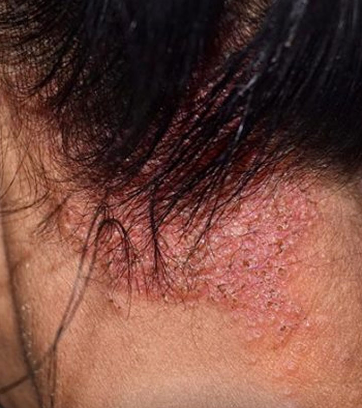 Antifungal treatment options for scalp infections