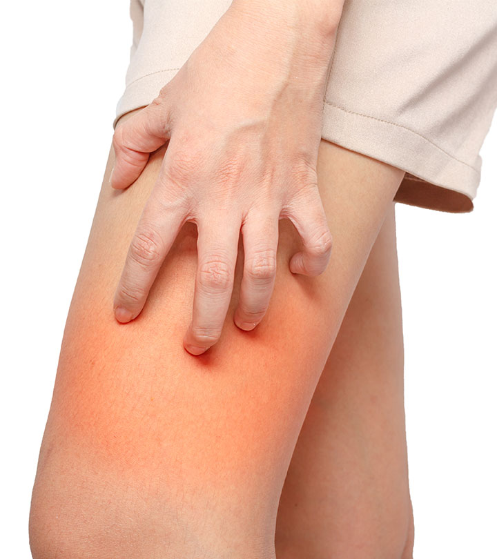 How to treat and prevent chafed skin
