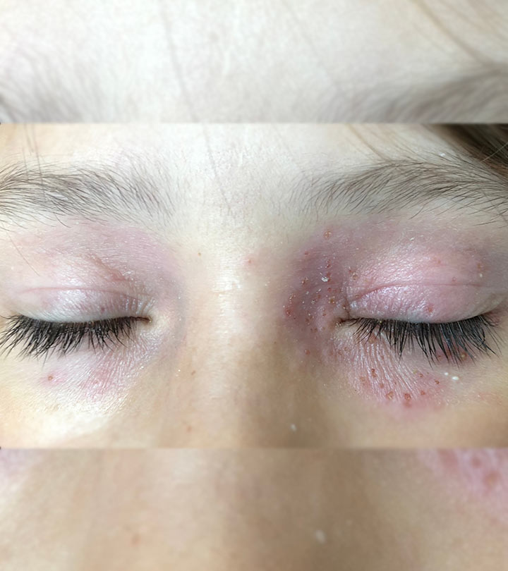 Puffy Eyes: Symptoms, Causes, Diagnosis, Treatment and Home Remedies