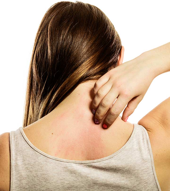 10 Home Remedies To Treat Rashes Under Breast 