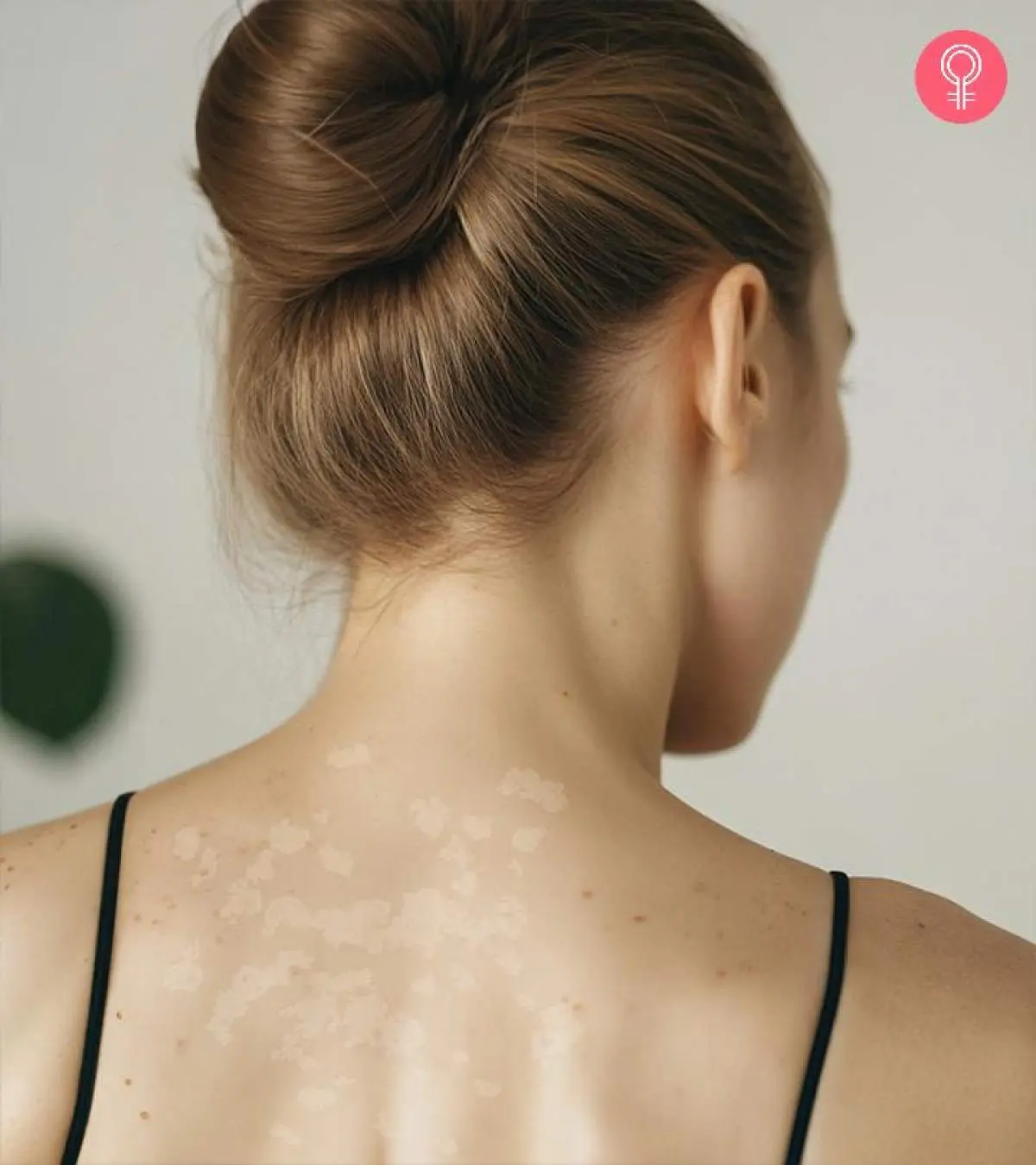 How To Get Rid Of Tinea Versicolor 15 Home Remedies To Try