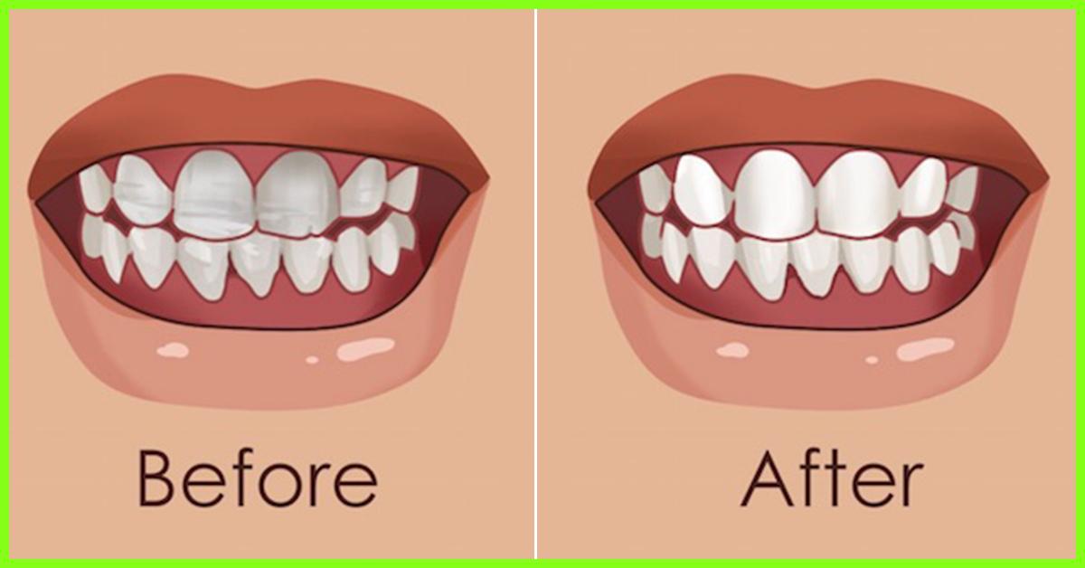 how-to-strengthen-loose-teeth-causes-and-home-remedies