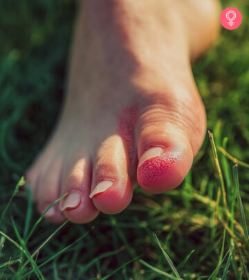 Home Remedies For Athlete’s Foot