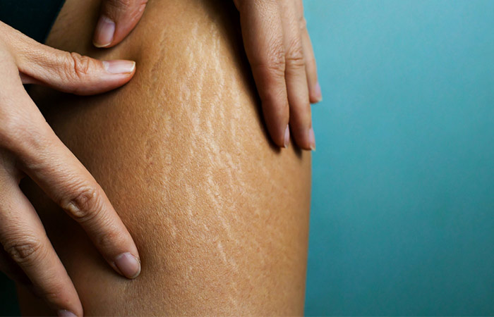 Stretch Marks On The Breasts: Causes, Treatment, Prevention, And