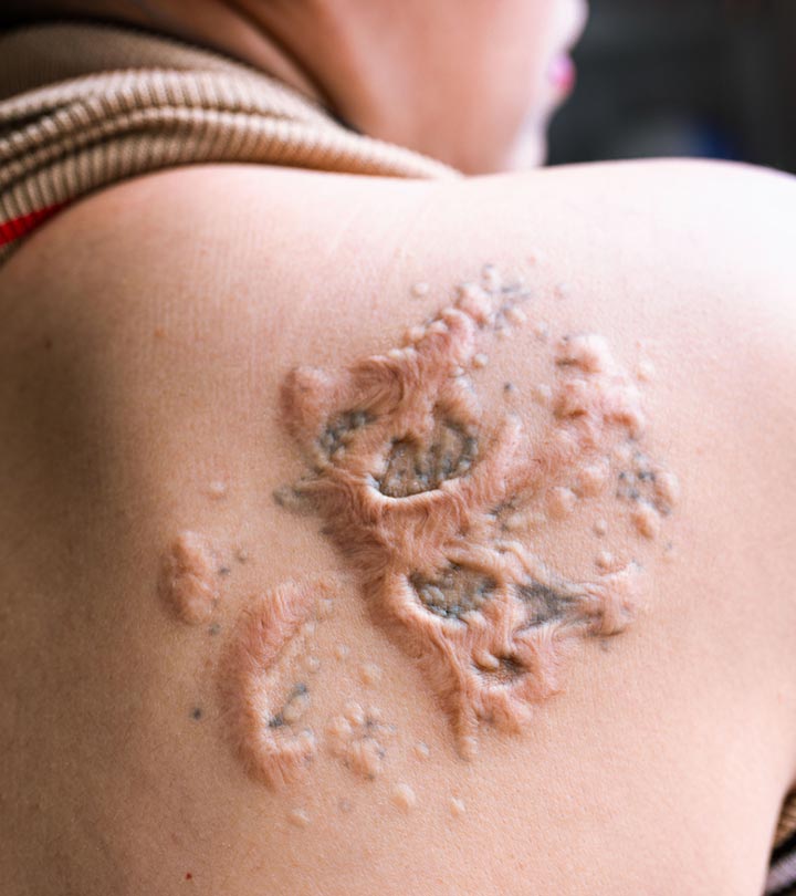 What Causes A Tattoo Rash How To Treat It