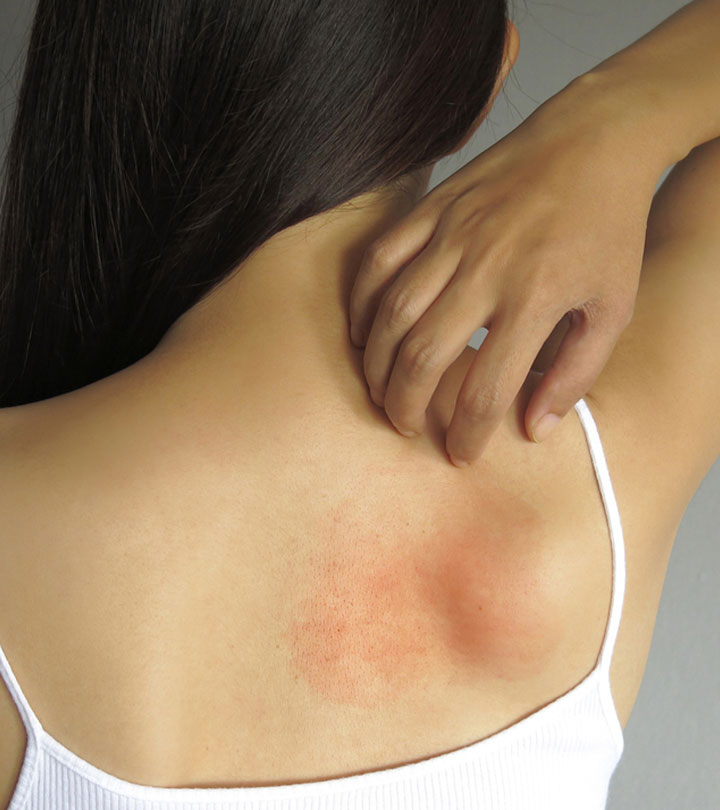 Psoriasis vs. Ringworm: What's the Difference?