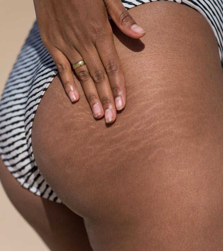 young celebrities with stretch marks