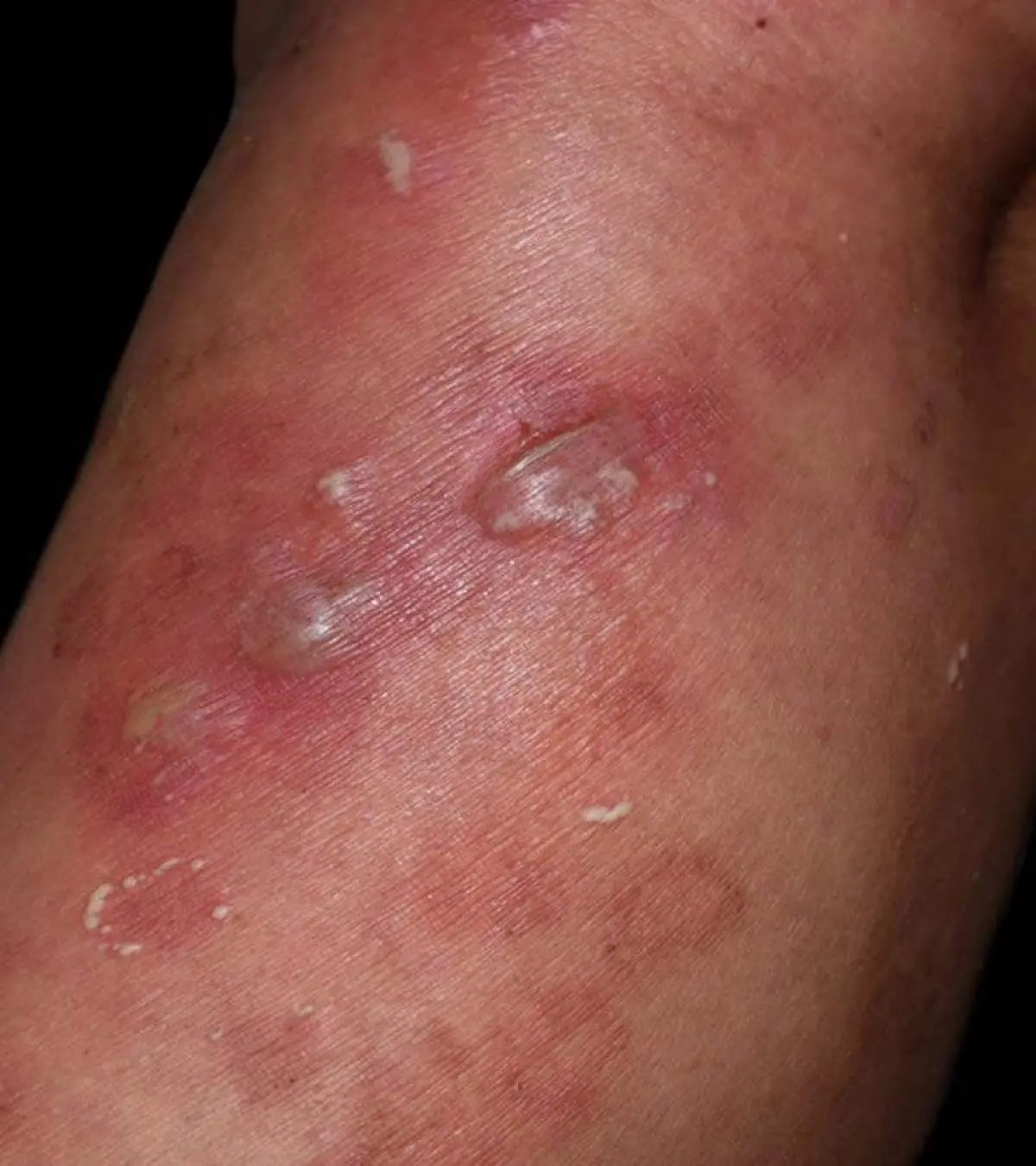 Vesicular Skin Lesions: Causes, Symptoms, Diagnosis, Treatment