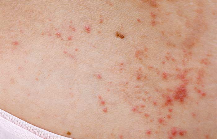 Prickly heat (heat rash): Images, treatment, causes, and more