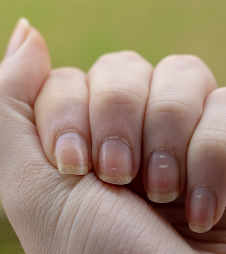white spots on your nails Signs of these diseases nz