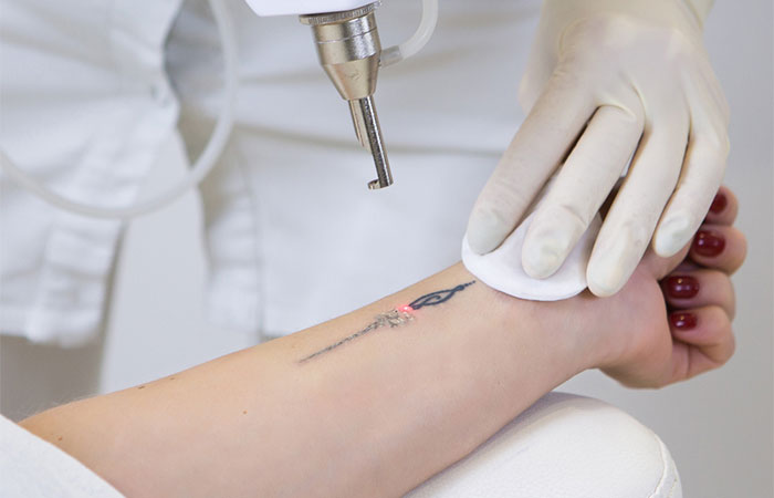Affordable Cost Tattoo Removal in Vizag, Andhra Pradesh