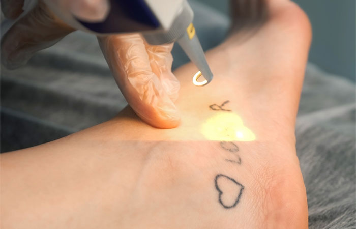 How Does Tattoo Removal Work | Skin Cancer & Cosmetic Surgery Center NJ