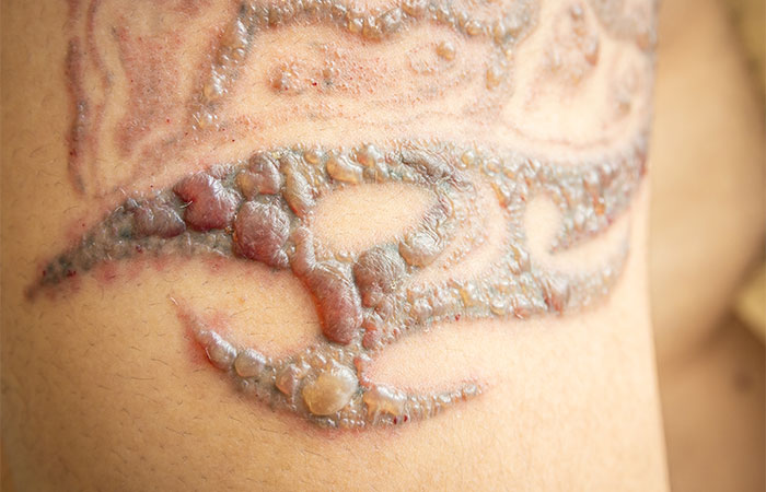 Aspergillus fumigatus infection on a home‐made tattoo - Kluger - 2014 -  British Journal of Dermatology - Wiley Online Library