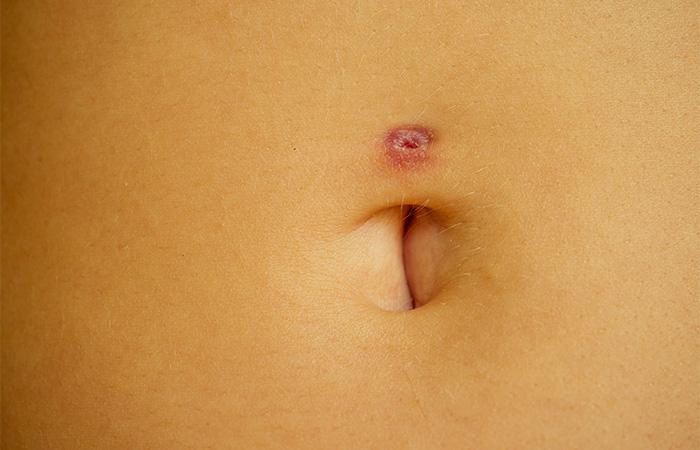 Infected belly button deals piercing treatment