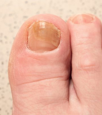 Toenail fungus on a woman’s foot